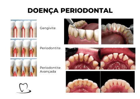 Como tratar a periodontite agressiva