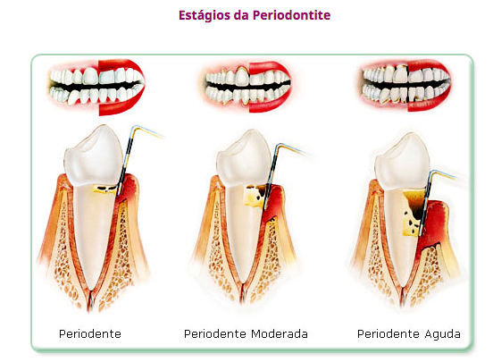Como tratar a periodontite avançada