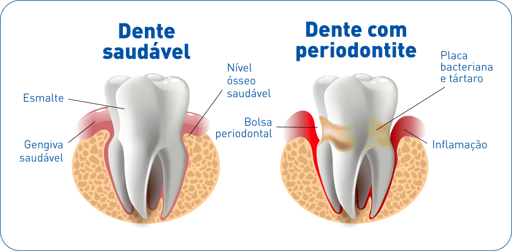 Como a Higienização Diária Impacta o Sucesso do Tratamento Periodontal