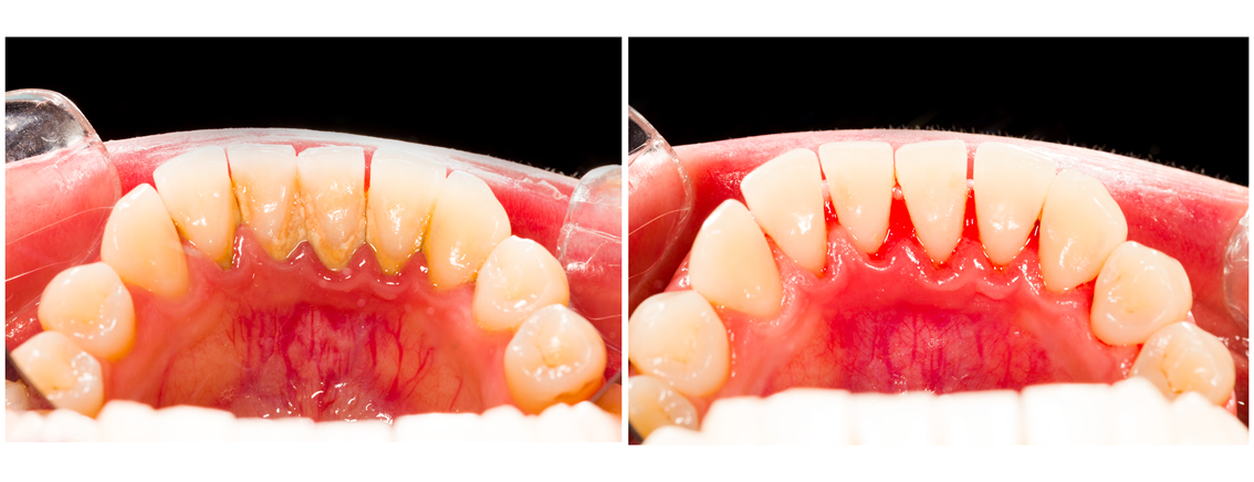 A Importância do Controle de Doenças Sistêmicas no Tratamento Periodontal