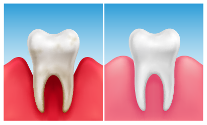 Como tratar a periodontite crônica
