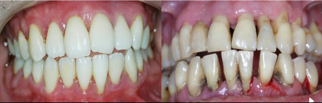 Quando a cirurgia periodontal é necessária?