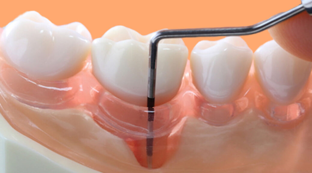 Mitos e verdades sobre o tratamento da periodontite