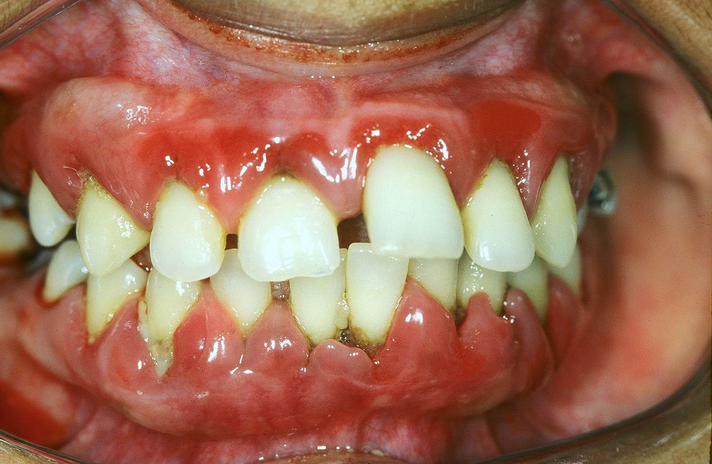Como a higiene oral afeta a periodontite
