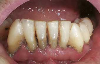 Regeneração Óssea Guiada: Uma Esperança para a Periodontite Severa