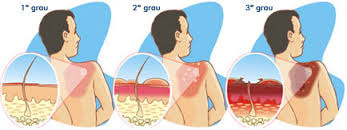 Como tratar a queimadura de sol