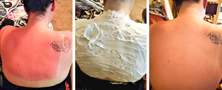 Prevenção de Queimaduras Solares: Dicas Essenciais