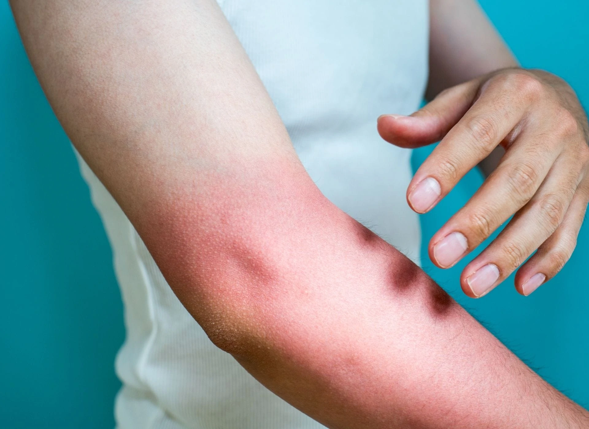 Cuidados Pós-Sol para uma Pele Saudável