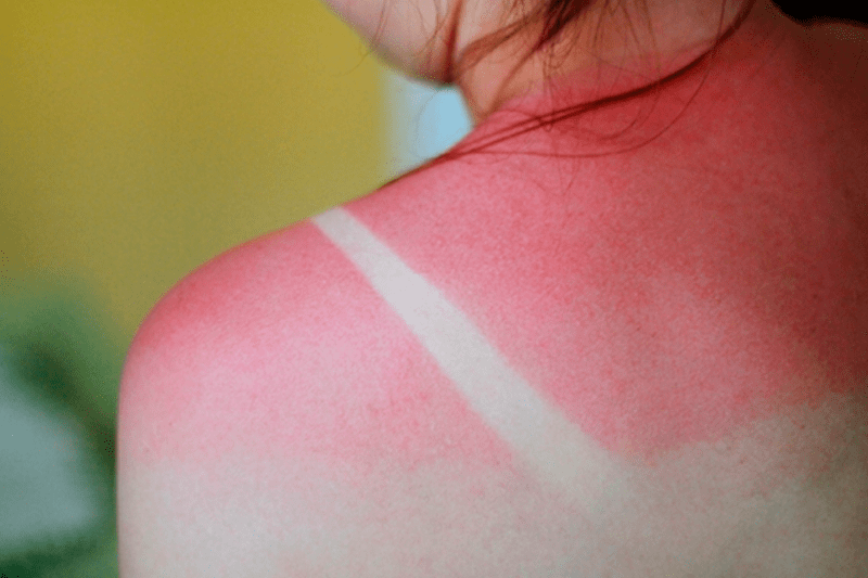 Mitos e Verdades sobre Queimaduras de Sol