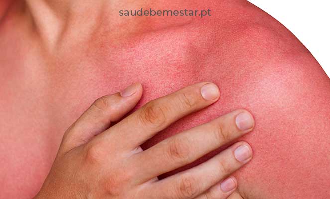 Os Melhores Produtos para Aliviar Queimaduras Solares