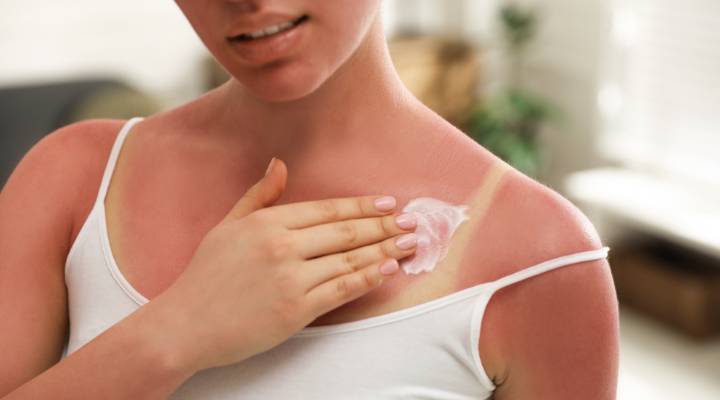 Como Identificar e Tratar Insolação