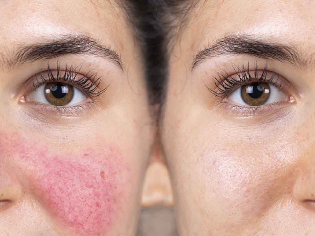 Guia Completo: Como Escolher o Protetor Solar Ideal para Rosácea