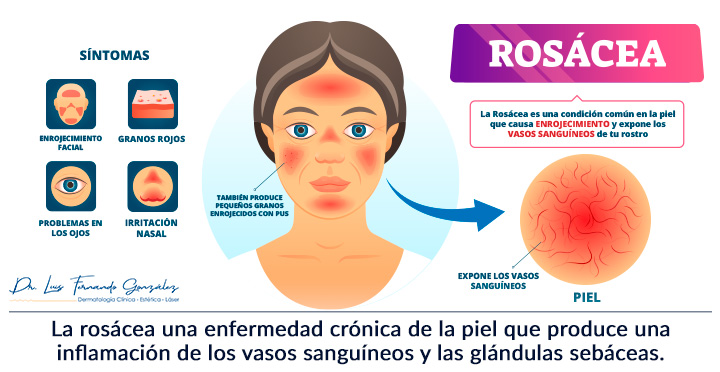 Alimentação e Rosácea: Descubra Quais Alimentos Podem Piorar Sua Condição