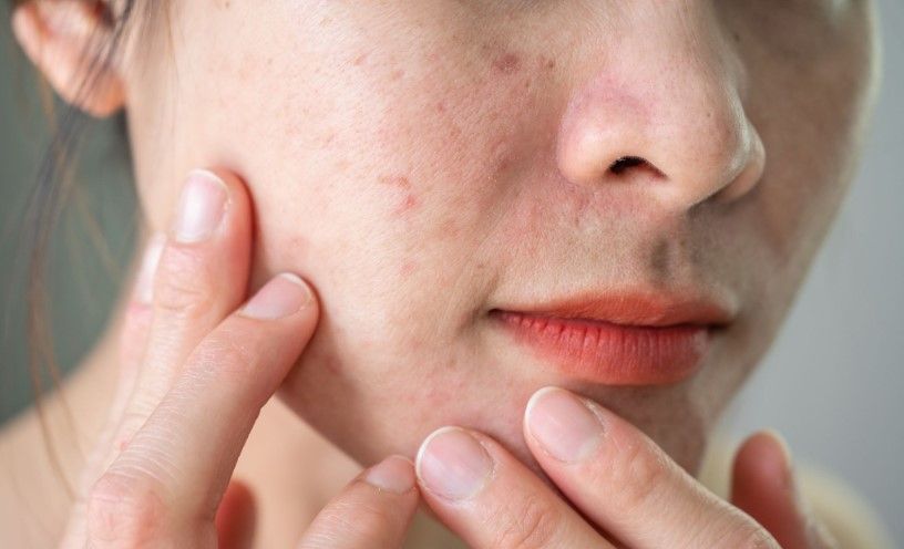 Guia Completo: Como Escolher o Protetor Solar Ideal para Rosácea