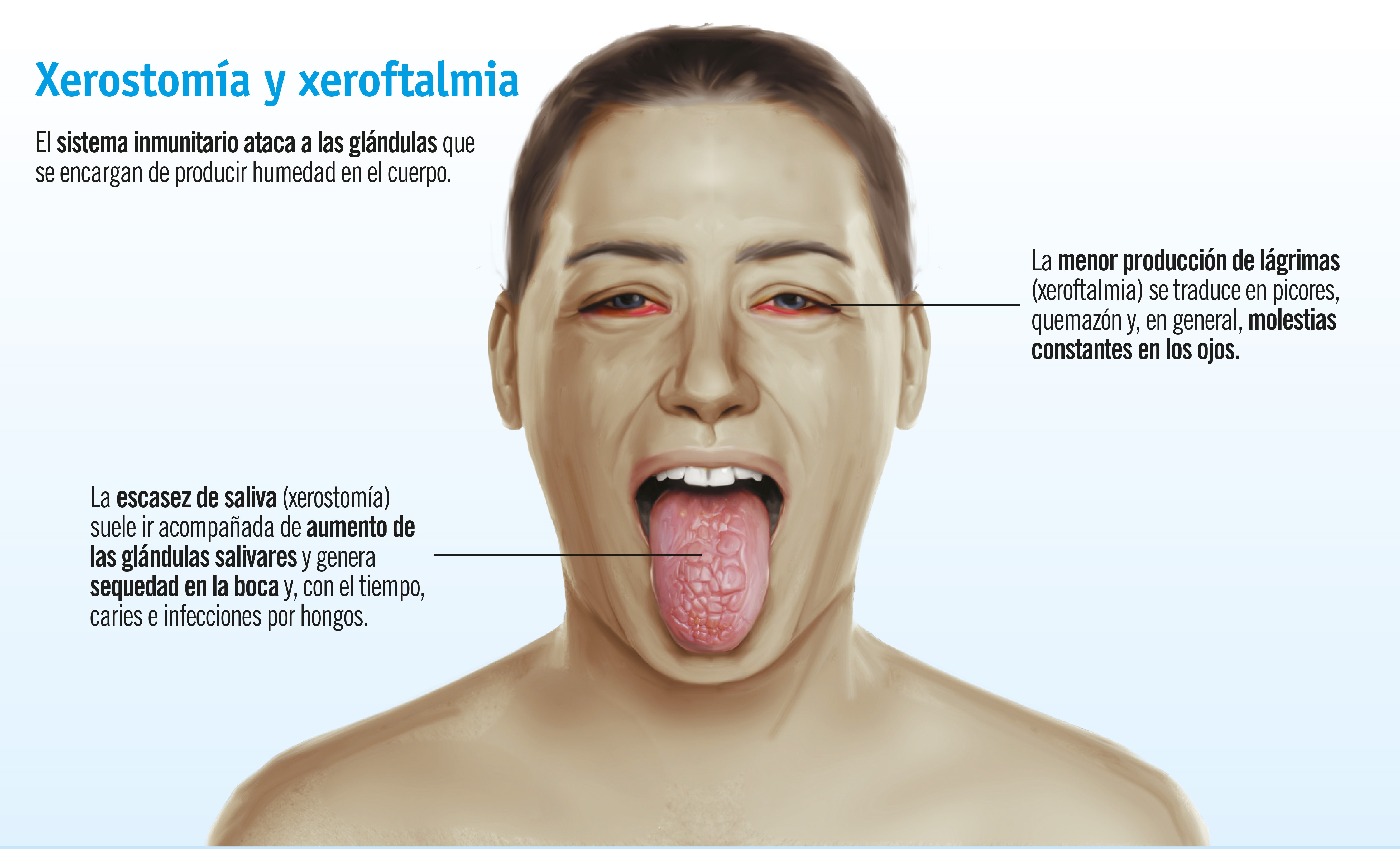 Como tratar a síndrome de Sjogren
