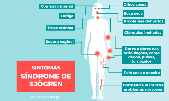 Como tratar a síndrome de Sjogren