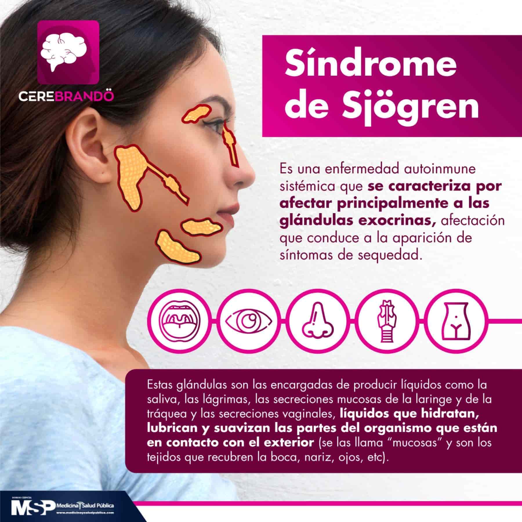 Como tratar a síndrome de Sjogren