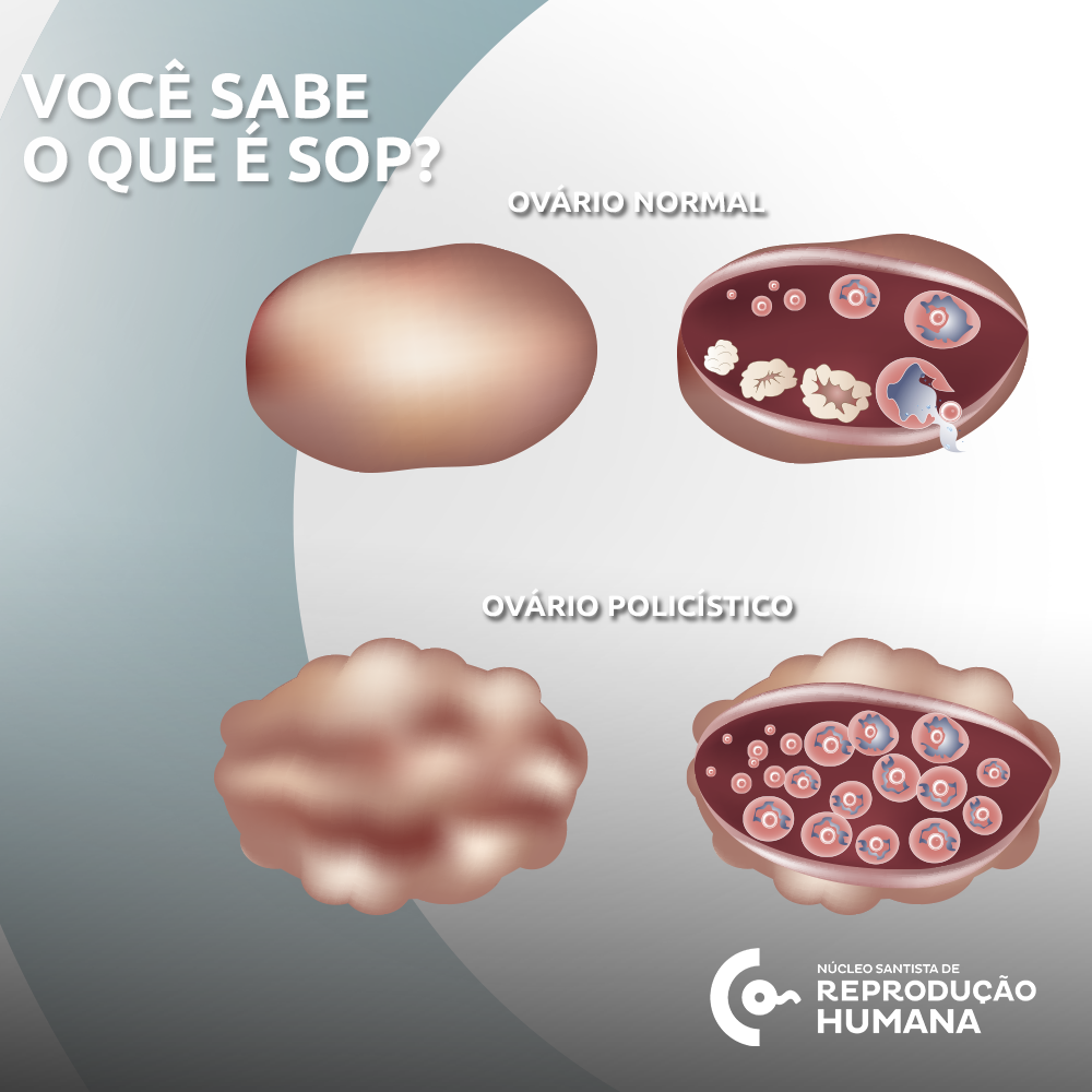 Dieta Ideal para SOP: Alimentos Permitidos e Proibidos; Exercícios Físicos que Ajudam no Controle da SOP; Como a Resistência à Insulina Afeta a SOP; Tratamentos Naturais para SOP: Mitos e Verdades; Fertilidade e SOP: Guia Completo para Engravidar; Riscos da SOP Não Tratada: Complicações a Longo Prazo