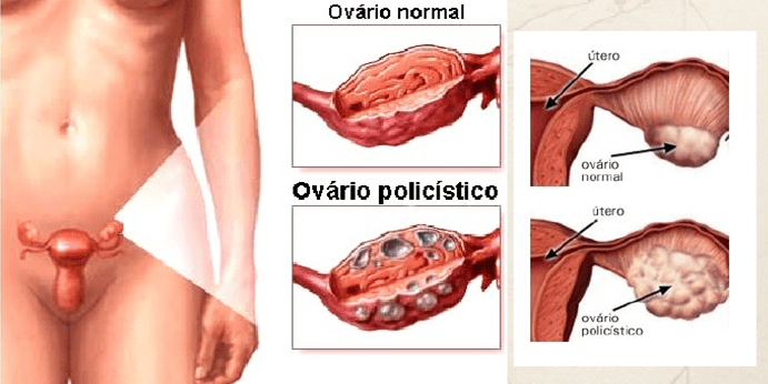 Dieta Ideal para SOP: Alimentos Permitidos e Proibidos; Exercícios Físicos que Ajudam no Controle da SOP; Como a Resistência à Insulina Afeta a SOP; Tratamentos Naturais para SOP: Mitos e Verdades; Fertilidade e SOP: Guia Completo para Engravidar; Riscos da SOP Não Tratada: Complicações a Longo Prazo