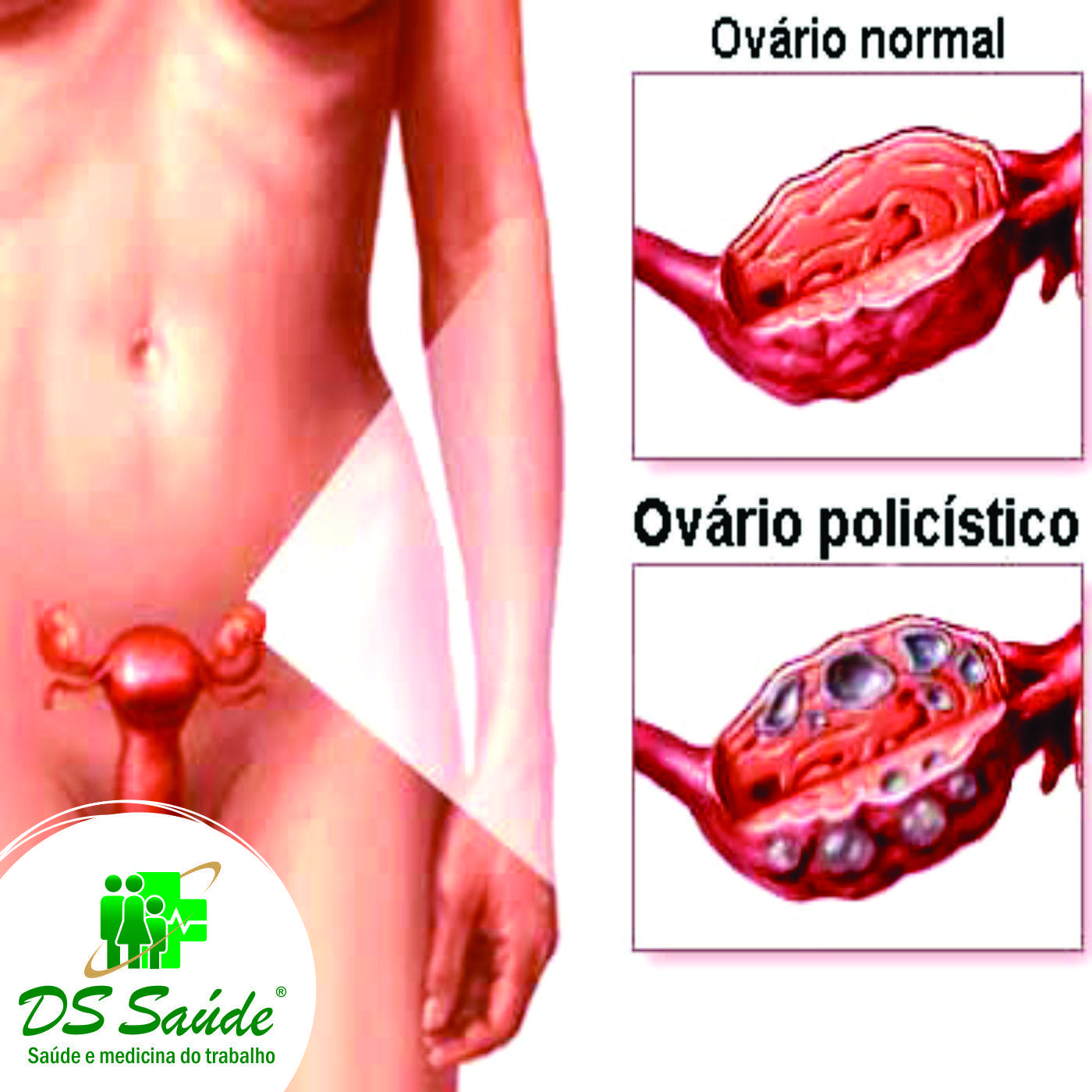 Como tratar a síndrome do ovário policístico