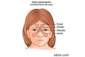 Como tratar a sinusite bacteriana em crianças