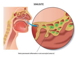 Como fazer lavagem nasal em bebês