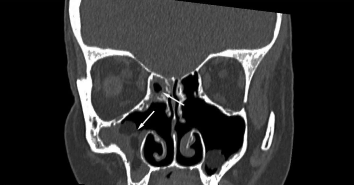 Diferenças entre Sinusite Esfenoidal e Frontal