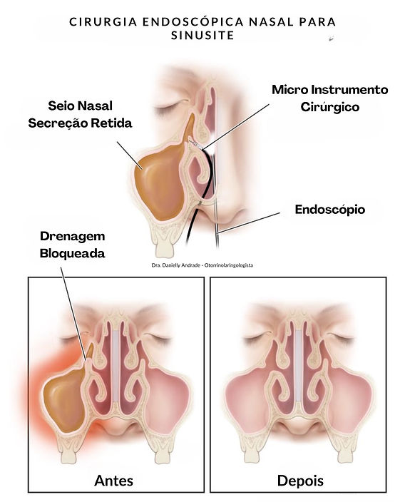 A importância da lavagem nasal no tratamento da Sinusite