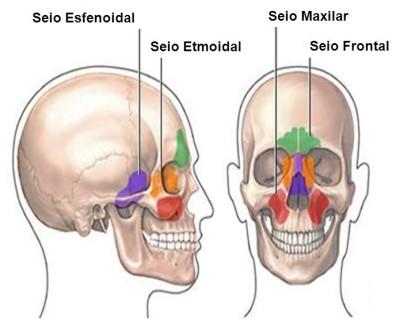 O que é Sinusite Esfenoidal?