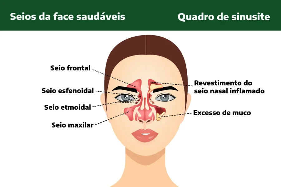 Exercícios para Aliviar a Sinusite Etmoidal