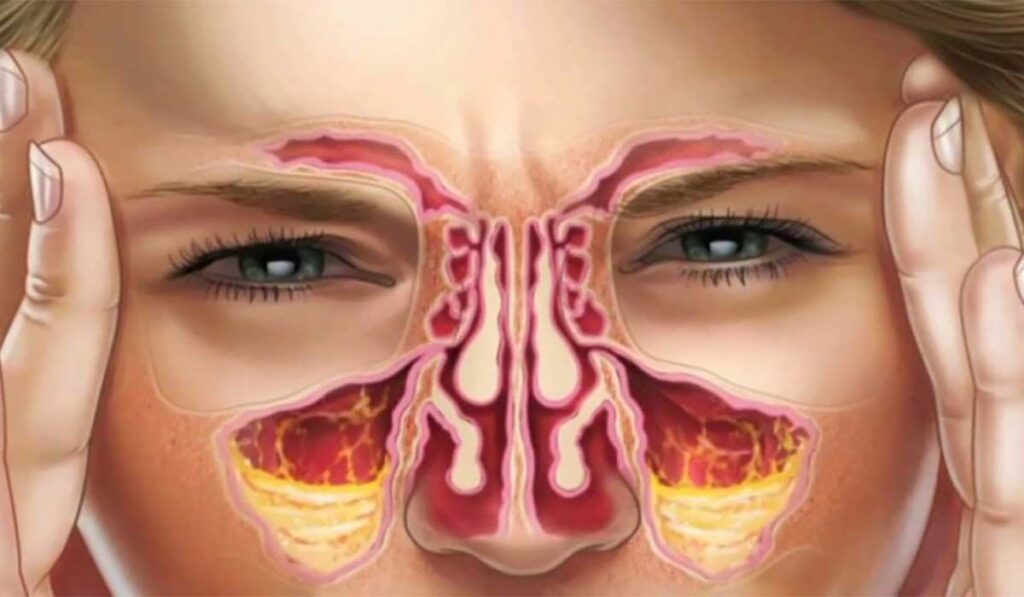 Antifúngicos Orais: Quando São Indicados para Sinusite?