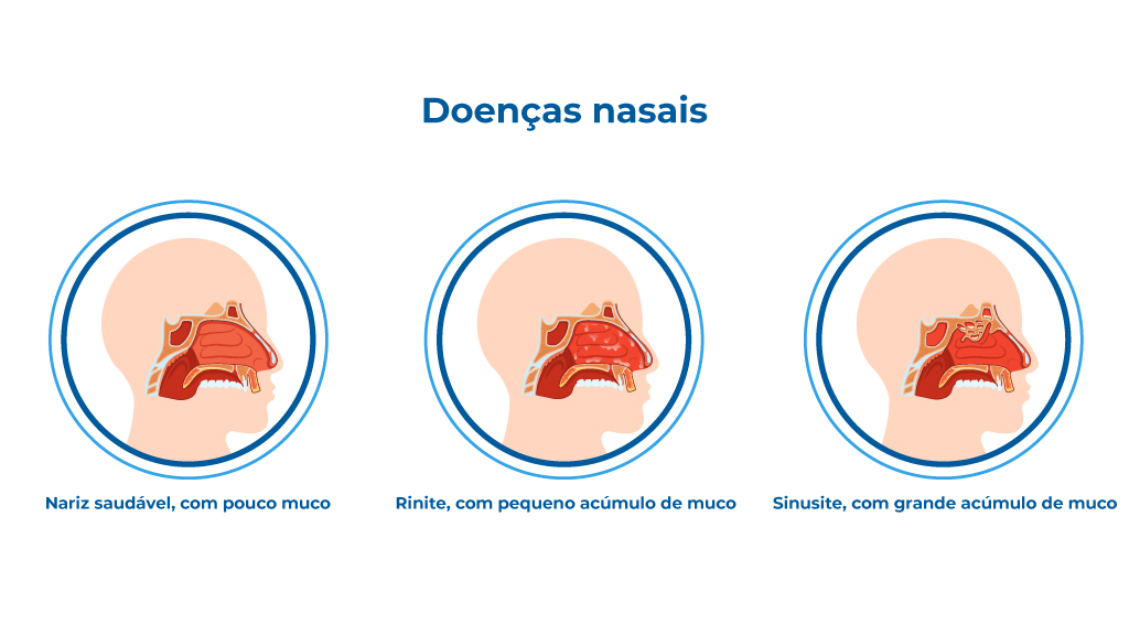 O Papel dos Corticosteroides no Tratamento da Sinusite Fúngica