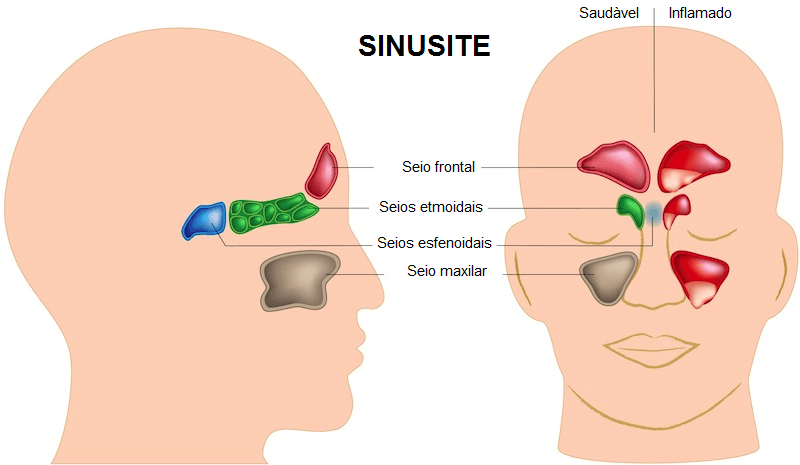 Remédios caseiros eficazes para sinusite