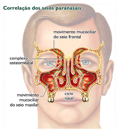 Como tratar a sinusite maxilar crônica