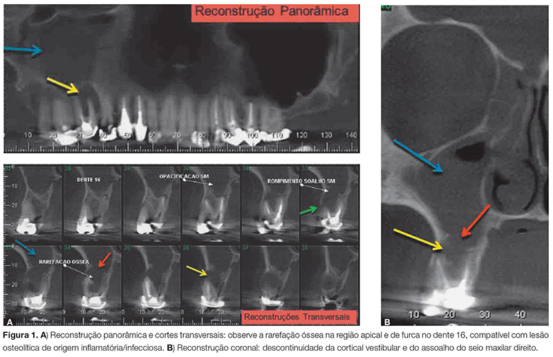 10 sinais de que sua sinusite pode ser crônica