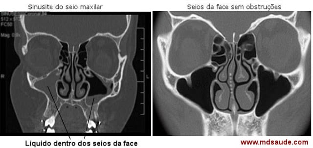 Como a origem odontogênica afeta a sinusite maxilar