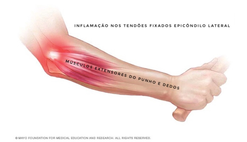 Infiltrações para Tendinite no Cotovelo: Quando São Indicadas?