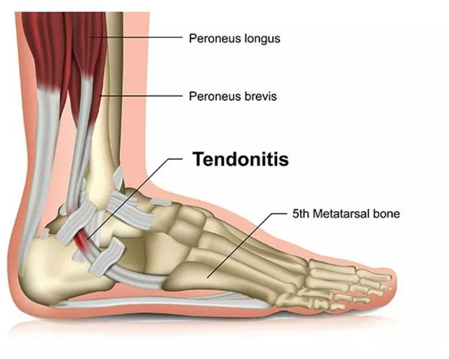 A Importância da Fisioterapia no Tratamento da Tendinite Crônica