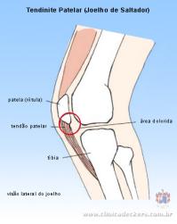 Prevenção de Tendinite: Dicas para Evitar Lesões nos Esportes