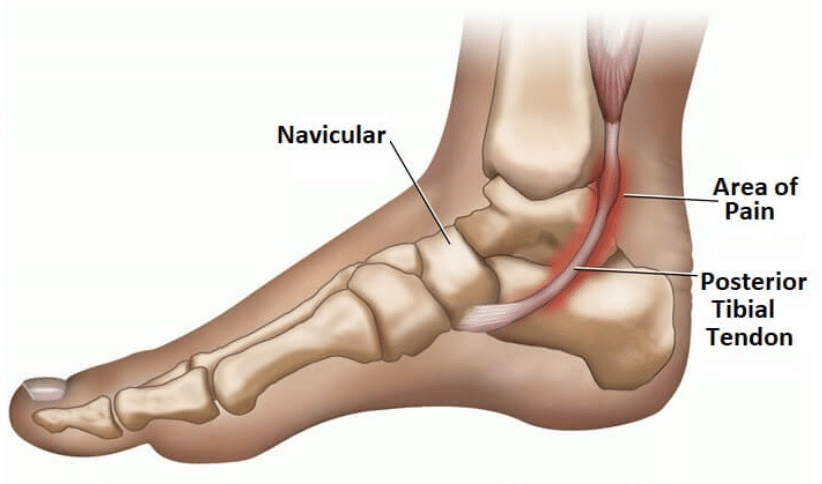 5 Exercícios Essenciais para a Recuperação da Tendinite Patelar