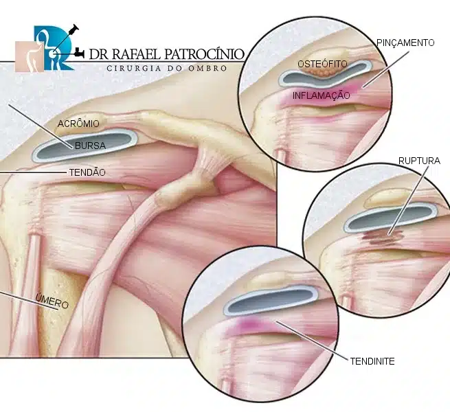 Entenda a Diferença: Tendinite vs. Bursite