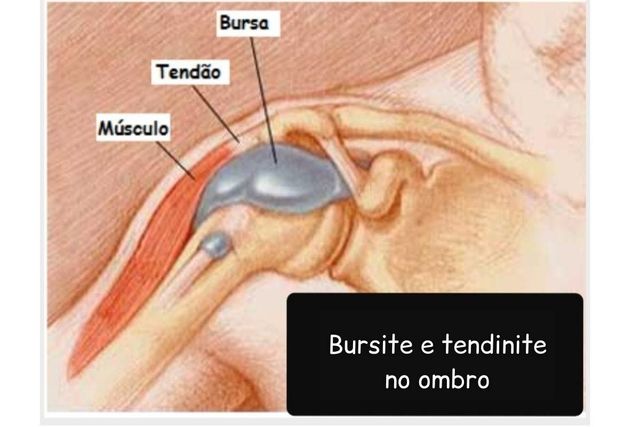 Guia Completo de Fisioterapia para Tendinite no Cotovelo