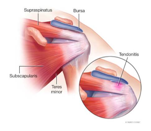 5 Exercícios de Alongamento para Tendinite no Ombro