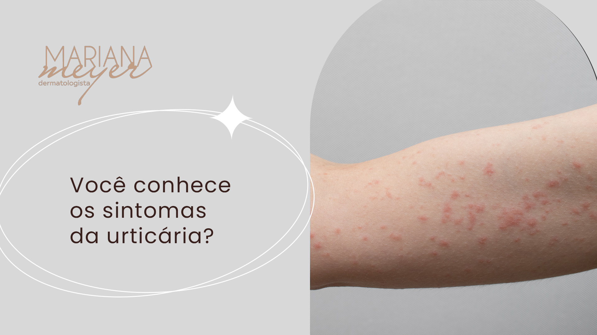 Como Identificar e Evitar Gatilhos da Urticária