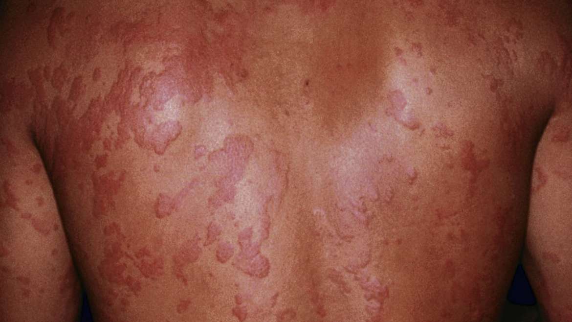 O Papel dos Anti-histamínicos no Tratamento da Urticária