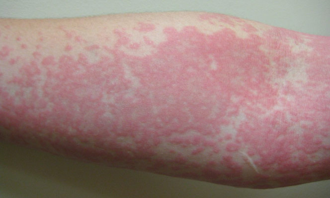 Urticária Crônica: Quando os Tratamentos Convencionais Falham