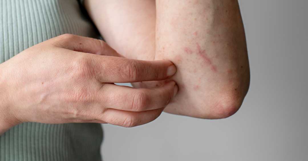 Sinais de Alerta da Urticária: Quando Ir ao Pronto-Socorro