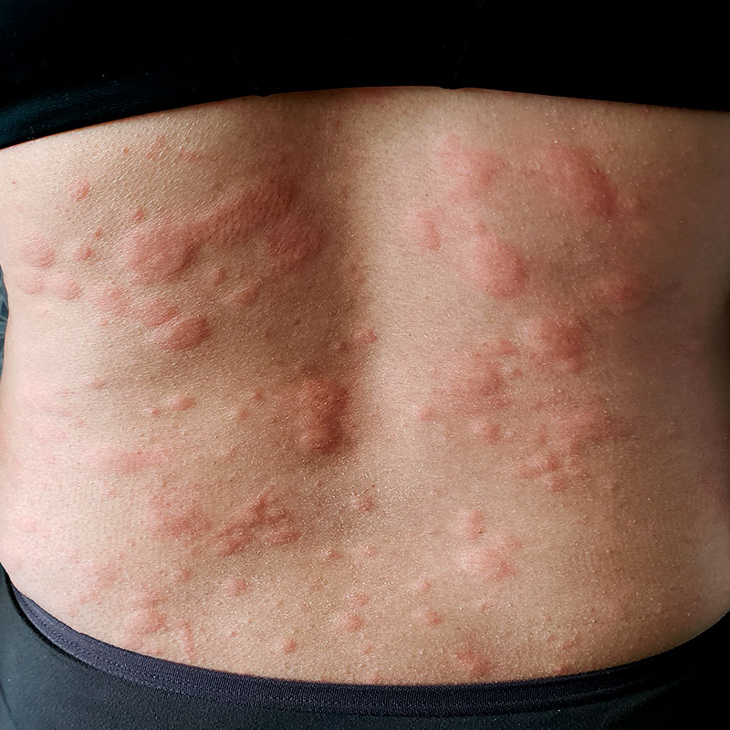 Como Identificar e Evitar Gatilhos da Urticária