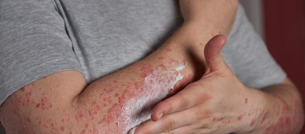 O Papel dos Anti-histamínicos no Tratamento da Urticária