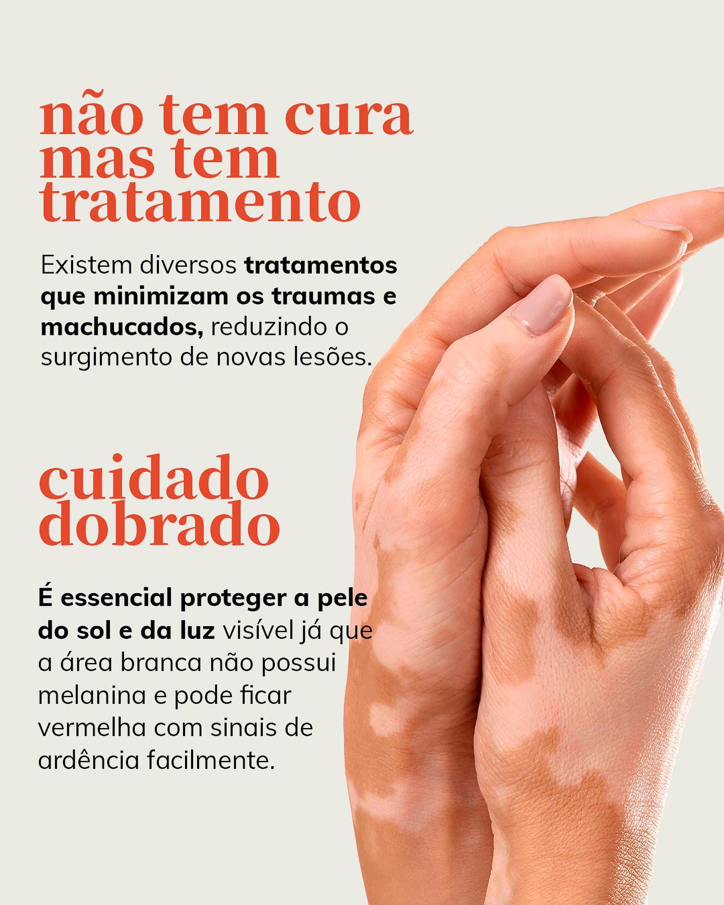 Como tratar o vitiligo